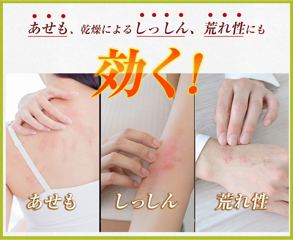 あせも、乾燥によるしっしん、荒れ性にも効く